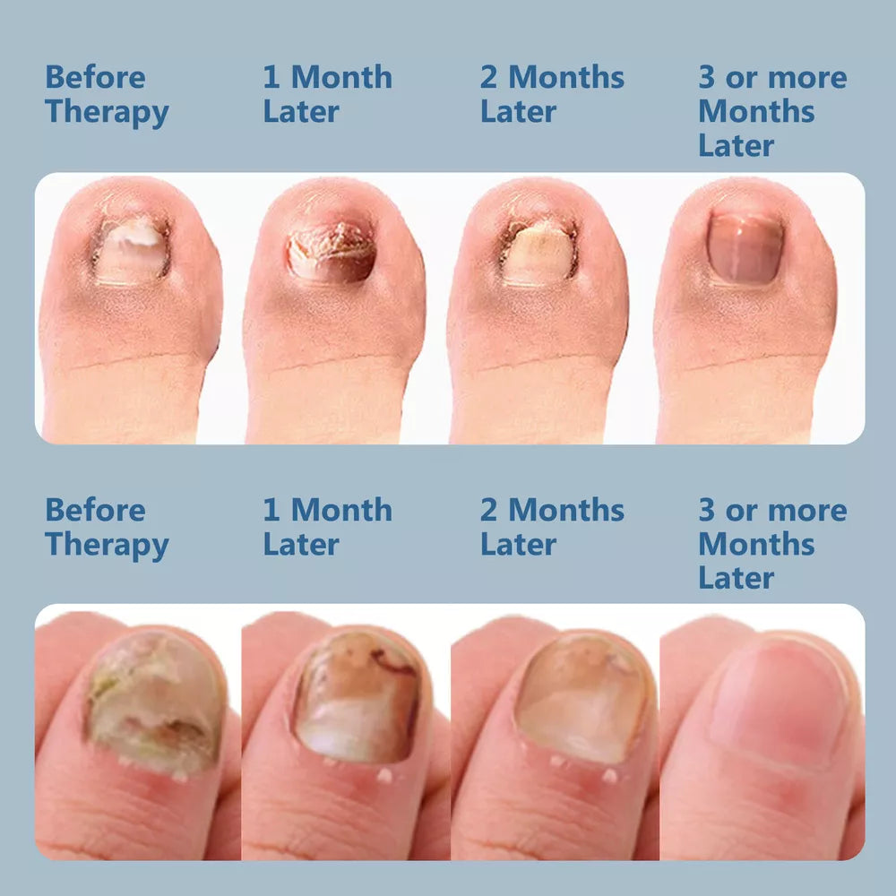 Laserbehandelingsapparaat tegen nagelschimmel met dubbele golflengte therapie