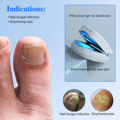 Laserbehandelingsapparaat tegen nagelschimmel met dubbele golflengte therapie