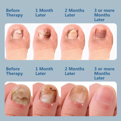 Laserbehandelingsapparaat tegen nagelschimmel met dubbele golflengte therapie