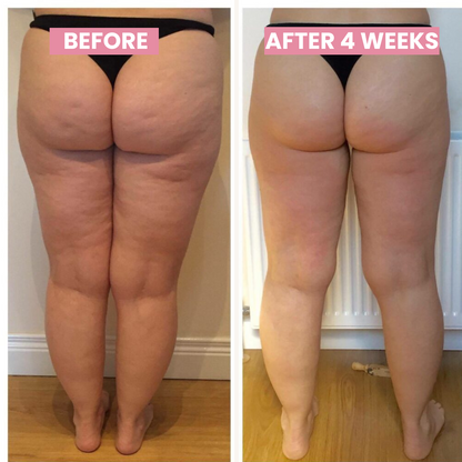 SlimCupp anti-cellulitis cupping apparaat met infraroodtherapie